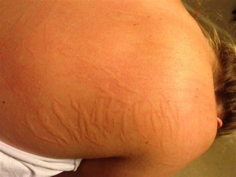 Itchy Skin Ends Up Like Welts Pic Babycenter