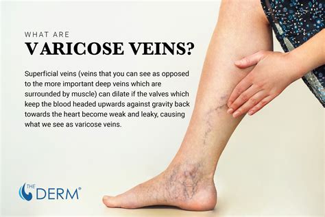 Varicose Veins Whats The Deal And How To Heal The Derm