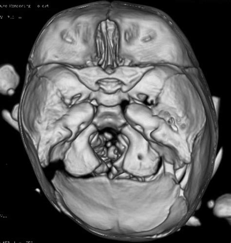 3d Reconstruction Ct Scan Of A 3 Year Old Male Patient With Scd Showed