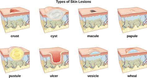 Skin Lesions Chart