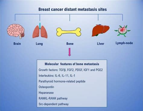 Breast Cancer Distant Metastasis Sites And Molecular Features Of Bone