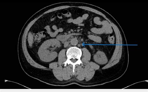 Ct Scan Of The Abdomen And Pelvis With Mesenteric Lymphadenopathy Ct