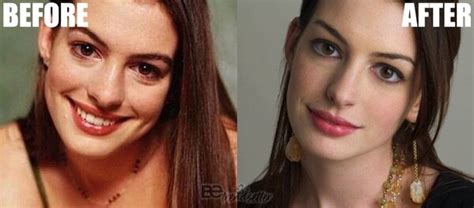 Anne Hathaways Plastic Surgery Before And After