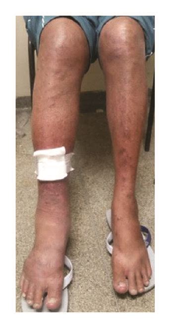 Case 4 Patient With Edema During Acute Dvt In Right Leg Download