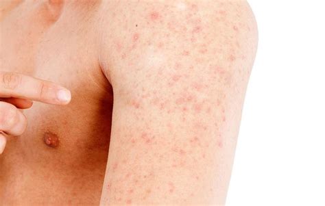 Dermatite Atópica O Que é Causas Sintomas E Tratamentos Cura Natural