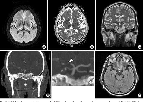Figure 2 From Acute Pseudobulbar Palsy After Bilateral Paramedian Thalamic Infarction A Case