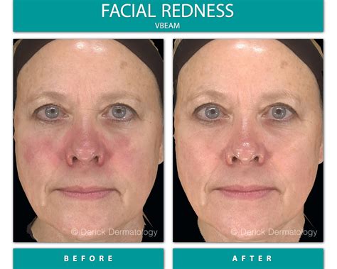 Rosacea Nose Before And After