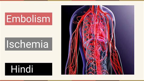 Embolism Ischemia Blood Clotsatherosclerosis Pulmonary Embolism In