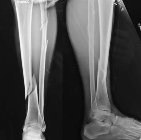 Preoperative X Ray Showing Distal Tibial Fracture With Proximal Fibular