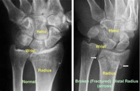 Distal Radius Fractures Broken Wrist Orthoinfo Aaos