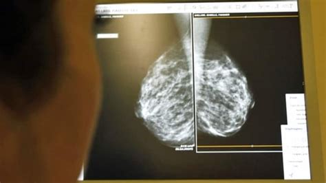 Are Doctors Over Diagnosing Cancer Cbc News