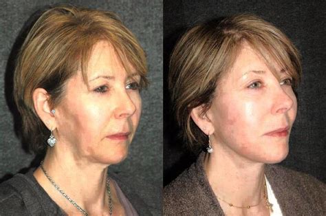 Deep Plane Facelift Before And After Facelift Info Prices Photos