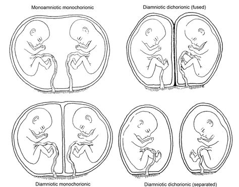 types of twins dizygotic monozygotic dichorionic and monochorionic