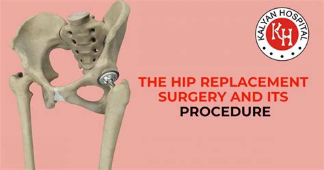 Hip Replacement Facts That Entail This Surgical Option