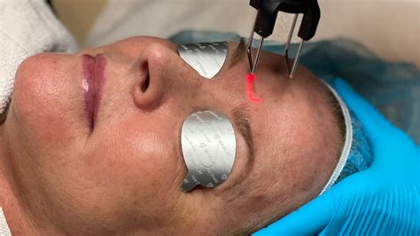 Co Laser In Indianapolis Phases Skin Care And Laser Center