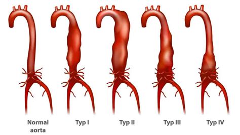 Abdominal Aortic Disease Maryland Vascular Specialists