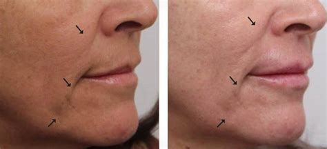 Oxygeneo Facials True Essence Skin And Laser Med Spa