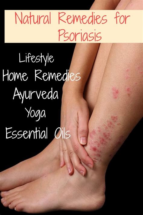 Natural Remedies For Psoriasis To Heal From Within Home Remedies For Psoriasis Natural