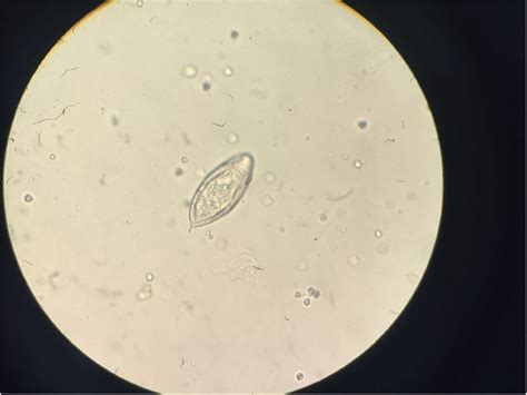 Urinary Schistosomiasis Report Of Case Diagnosed In Bladder Biopsy