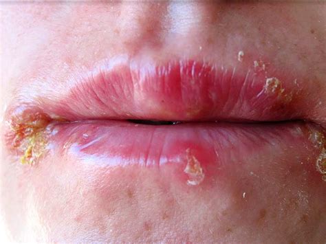 It may result in small blisters in groups often called cold sores or fever blisters or may just cause a sore throat. What Are The Natural Remedies For Herpes - lifealth