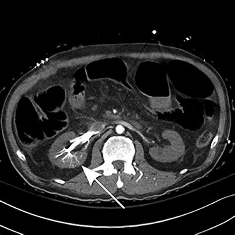 Axial Image From A Contrast Enhanced Ct Of The Abdomen And Pelvis
