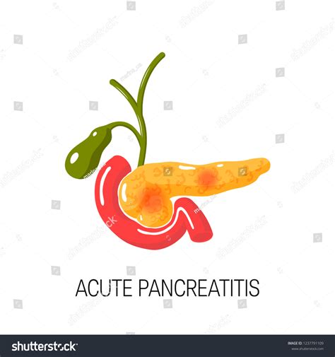 Acute Pancreatitis Concept Medical Vector Illustration Stock Vector