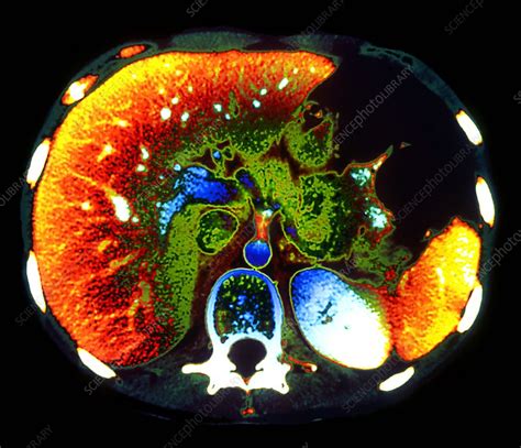 Liver Ct Scan Stock Image P5300141 Science Photo Library