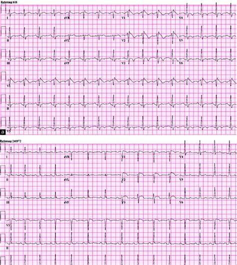 Twelve Lead Electrocardiograms Showing Brugada Electrocardiogram