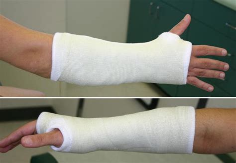 Broken Wrist Cast