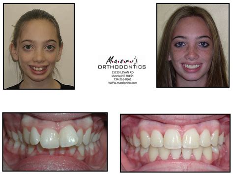 Open Bite Jaw Surgery And Braces Before And After Treatment