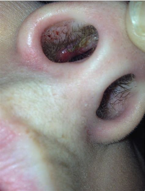 Another possibility is that that the nose is scarred. Yellowish Scabs on the inside of nose (Pictures to help ...