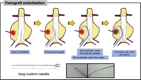 Transgraft Embolization By Using Long Needle For The Treatment Of Type