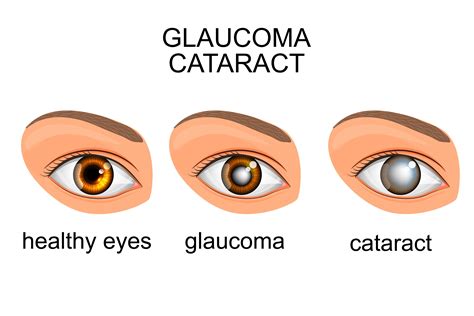 Differences Between Cataract And Glaucoma Shinagawa Blog