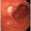 Peptic Ulcer Disease Workup Approach Considerations Endoscopy 