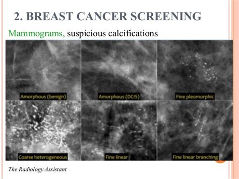đo Thị Ngọc Hiếu Breast Cancer Epidemiology And Screening In Vie