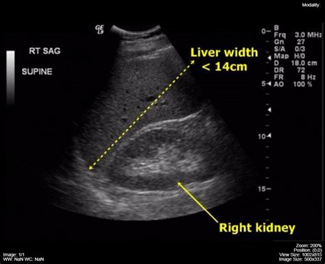 Ultrasound Of Normal Liver