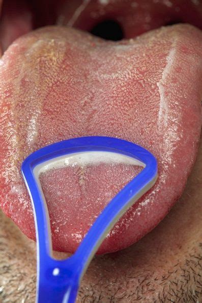 Sure… there are lots of other tongue cleaners out there. By keeping your tongue clean with the use of a scraper you ...