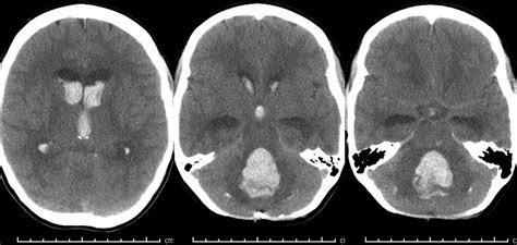 Delayed Fatal Intracranial Hemorrhage In A Pediatric Patient Following