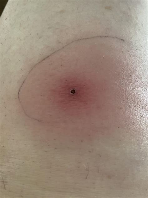 Could This Be A Brown Recluse Bite Brownreclusebites