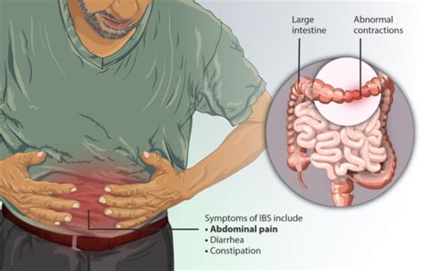 New Research Reveals Mechanism That Causes Irritable Bowel Syndrome