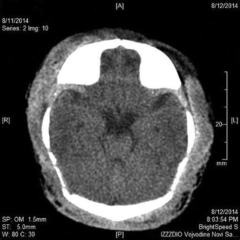 A Head Ct Reveals Cerebral Edema And Massive Subgaleal Hemorrhage