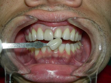 How to protect a previously chipped tooth? Los Angeles Dentist Blog - Dr Arthur A. Kezian DDS