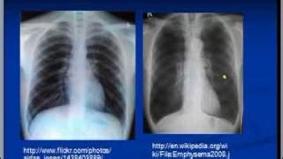 Chest X Ray Interpretation COPD And Emphysema Doovi