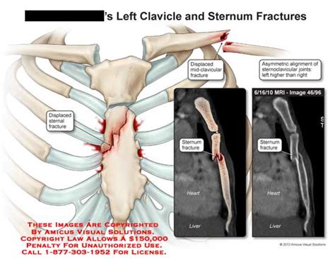 Amicus Illustration Of Amicusinjuryclaviclesternumfracture