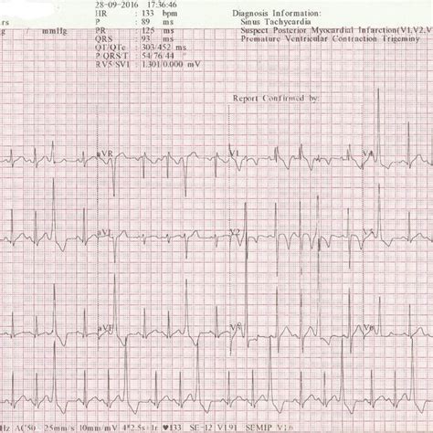 An Ecg Showing Sinus Rhythm With Ventricular Trigeminy Normal Axis