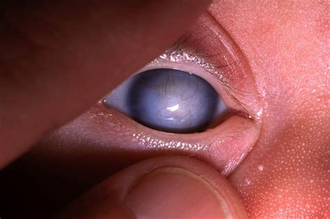 Corneal Clouding May Portend Vision Loss In Patients With Congenital