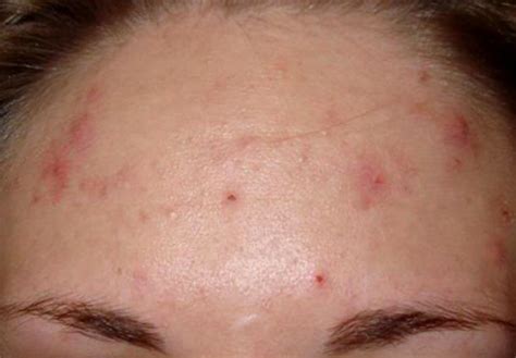Pimples On Forehead The Science Of Acne Крем против старения