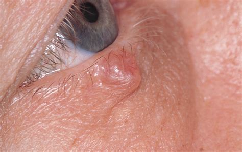 Asymptomatic Eyelid Papule In A 57 Year Old Healthy Man Dermatology