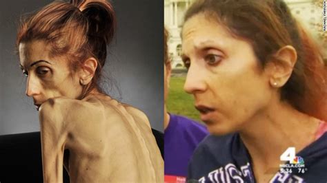 Anorexic Woman Who Weighed Only 40 Pounds Reveals Dramatic Transformation Fox 5 San Diego