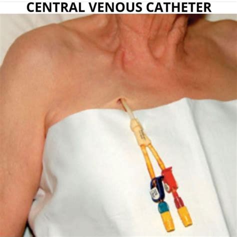 Central Venous Catheters Cvc Medizzy